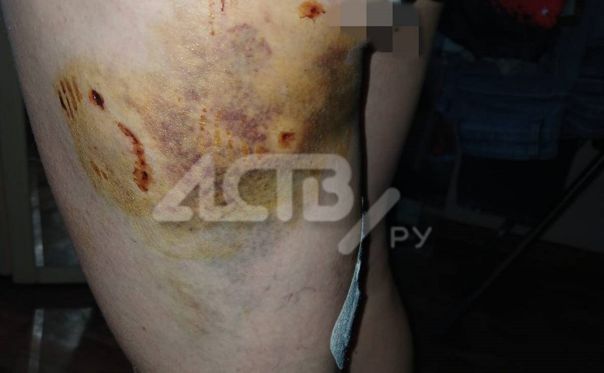 Стая агрессивных собак порвала ногу женщине в Холмске