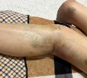 Раздроблен сустав: семья пострадавшей на сахалинском брекватере девушки намерена пойти в суд