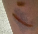 Агрессивная такса напала на южносахалинку и укусила за ногу