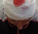 Житель Южно-Сахалинска получил травму головы от стеклянной бутылки, выброшенной из окна