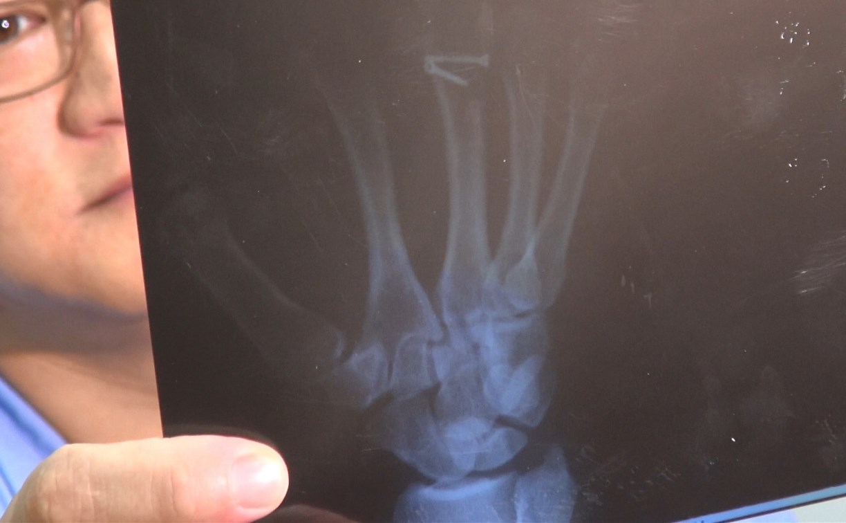 Сахалинские врачи спасли пациенту палец, пришив его к животу 