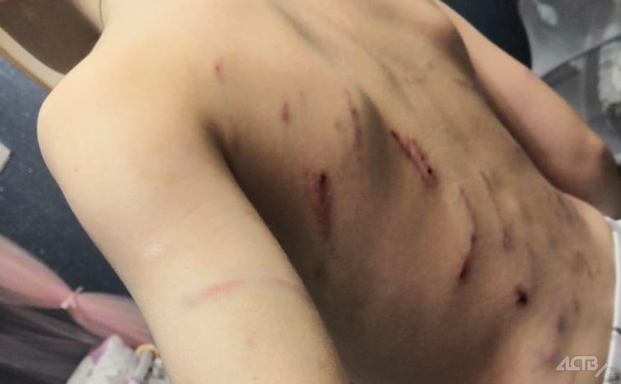 Агрессивная стая собак до крови искусала ребёнка на Сахалине