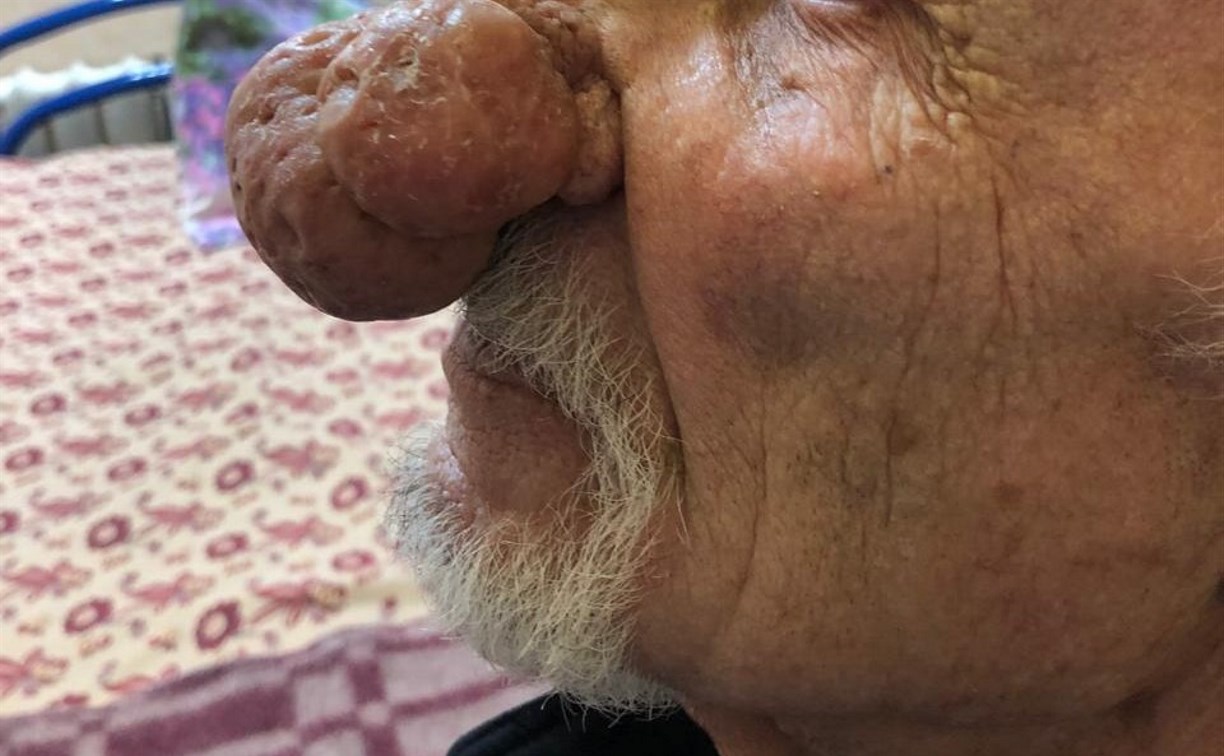 Редкую операцию сделали 77-летнему пациенту южно-сахалинские врачи