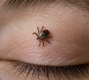 Врачи достали клеща из века пятилетней девочки