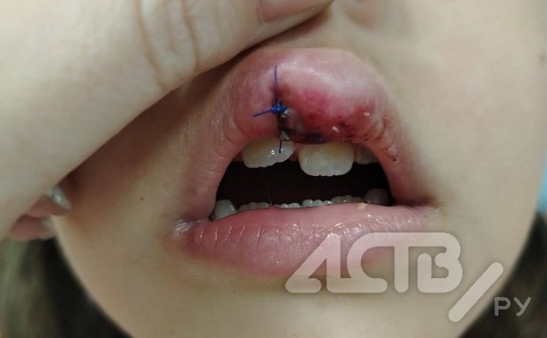 "Надвое рассечена губа, повело зубы": 6-летняя девочка получила травму на площадке во дворе в Южно-Сахалинске