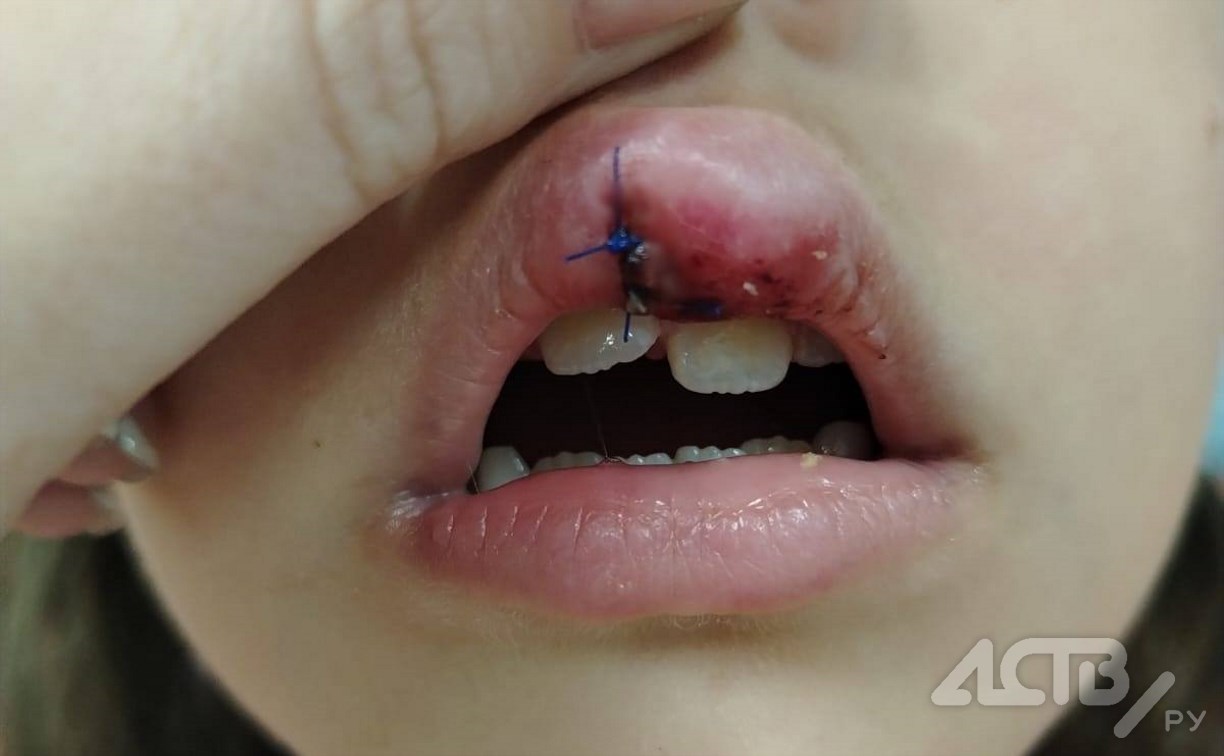 "Надвое рассечена губа, повело зубы": 6-летняя девочка получила травму на площадке во дворе в Южно-Сахалинске