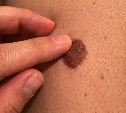 Дерматолог предупредила о смертельной опасности, которую таят родинки