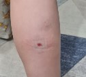 Девочку в Дальнем покусала овчарка, её хозяин был рядом и не помог ребенку 