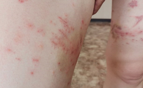 Ядовитое растение, от которого нет лекарства, обнаружили в центральном сквере Южно-Курильска