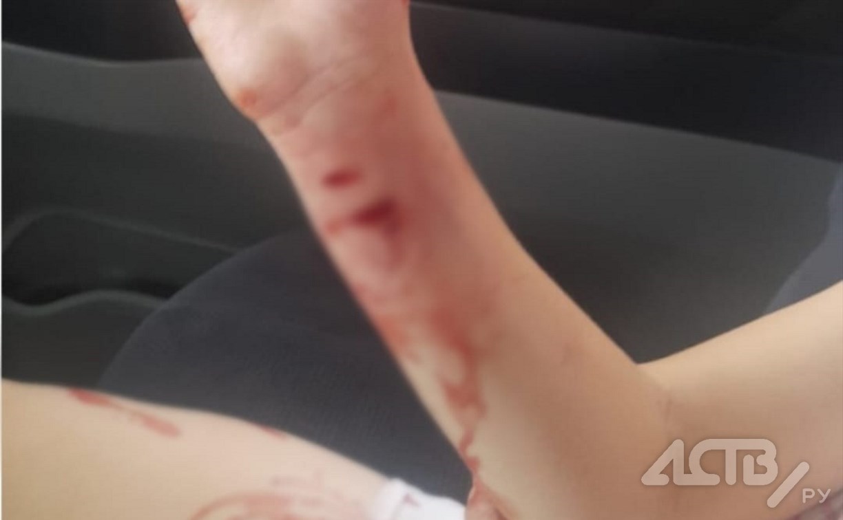 Десятилетнюю девочку укусила бездомная собака в Холмске