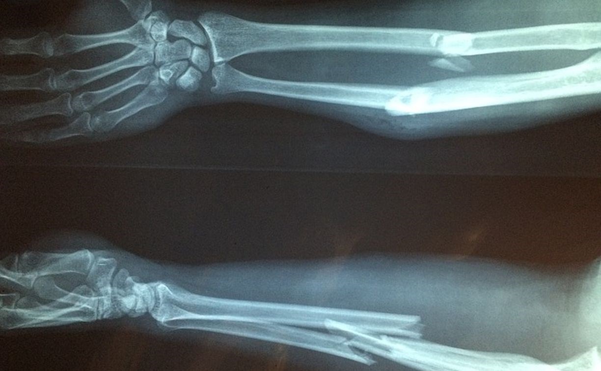 Камчатская школьница сломала руку из-за одноклассницы, а наказали директора