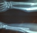 Камчатская школьница сломала руку из-за одноклассницы, а наказали директора