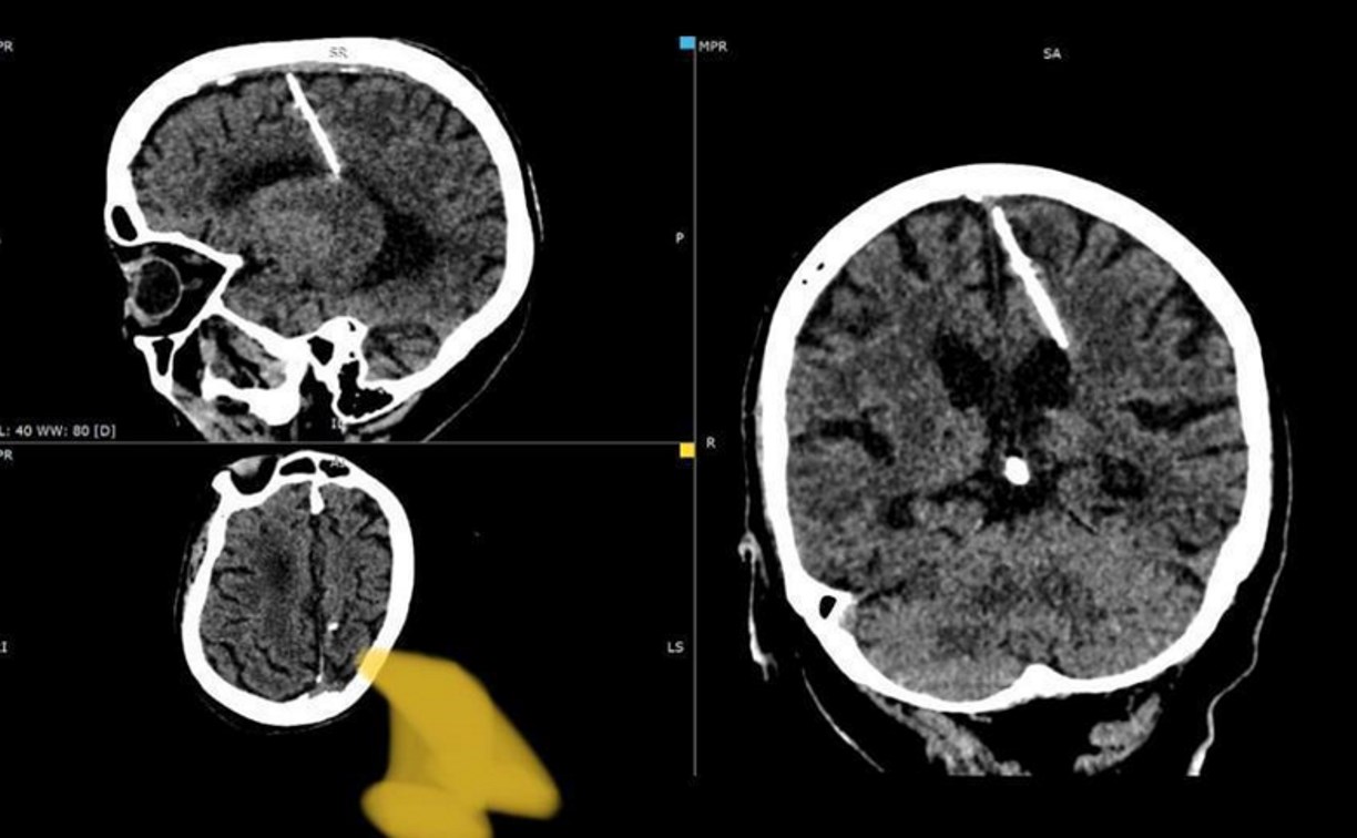 Врачи обнаружили трёхсантиметровую иглу в мозгу 80-летней сахалинки