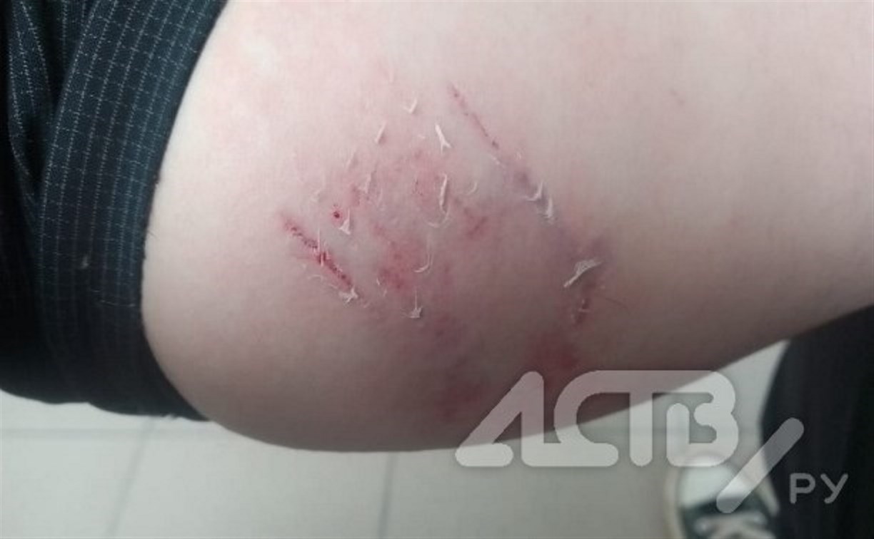 Следователи возбудили уголовное дело из-за нападения собаки на девушку в Долинске