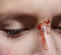Соцсети: хаски укусил за лицо и ногу мальчика в Холмске 