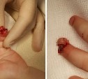 Сахалинский врач пришил ребёнку оторванную часть пальца