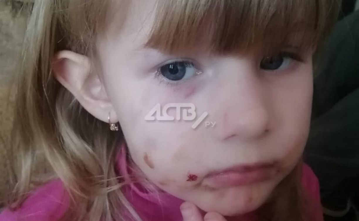 На Сахалине собака набросилась на 4-летнюю девочку и покусала ей лицо |  24.01.2022 | Южно-Сахалинск - БезФормата