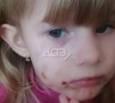 На Сахалине собака набросилась на 4-летнюю девочку и покусала ей лицо
