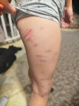 Стая собак до крови разодрала спину ребёнку на Сахалине, Фото: 2